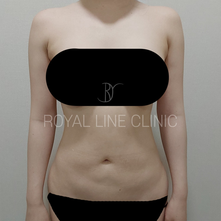 High-volume liposuction and safety