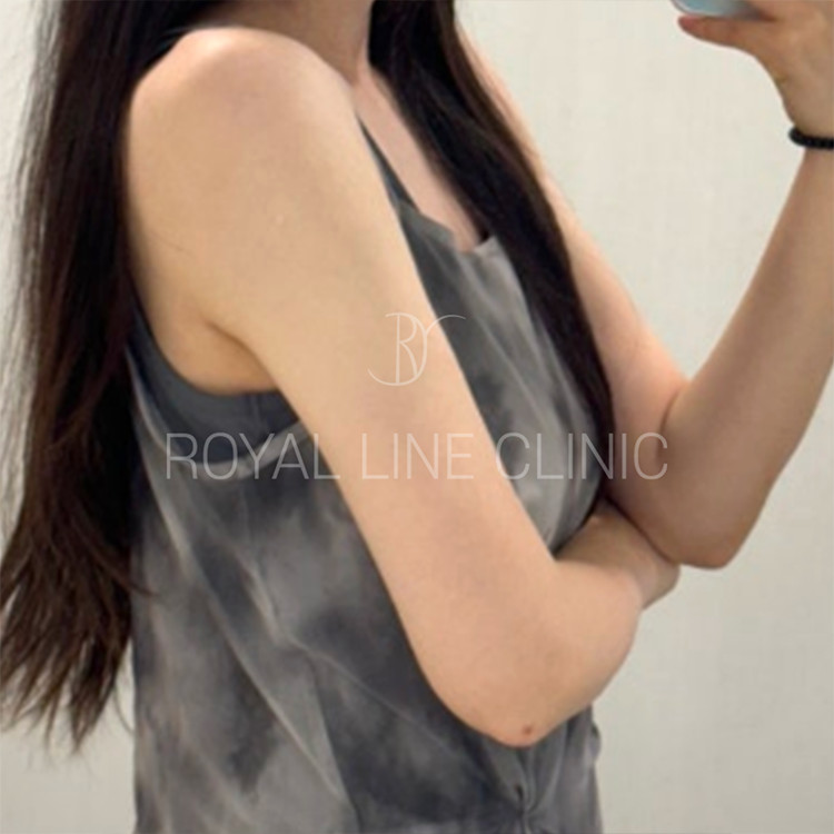 Chin and face liposuction — jawline definition